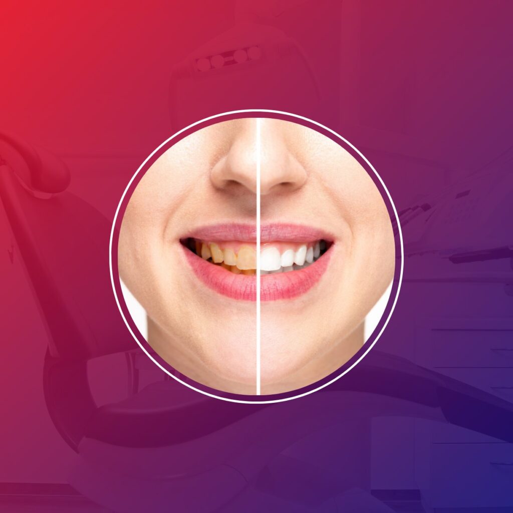 Teeth Whitening Clinic in hisar