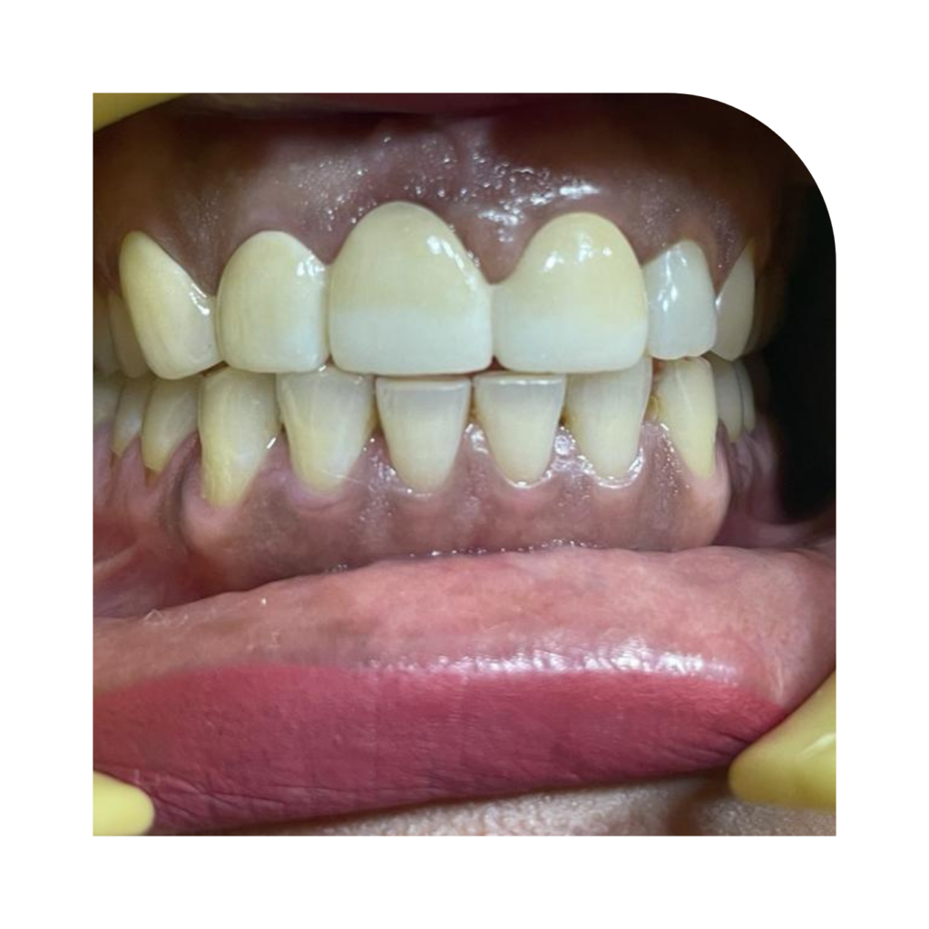 Ceramic Crowns treatment